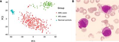 Torque teno mini virus driven childhood acute promyelocytic leukemia: The third case report and sequence analysis